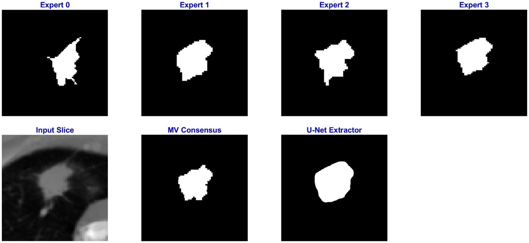 Radiologists’ annotations of an LIDC-IDRI lesion along with the MV consensus, and the
                    contour produced by our U-Net segemantation algorithm.
