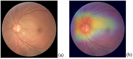 (a) Fundus image example, diagnosed with glaucoma, and its Grad-CAM result (b). It highlights the affected area of glaucoma.